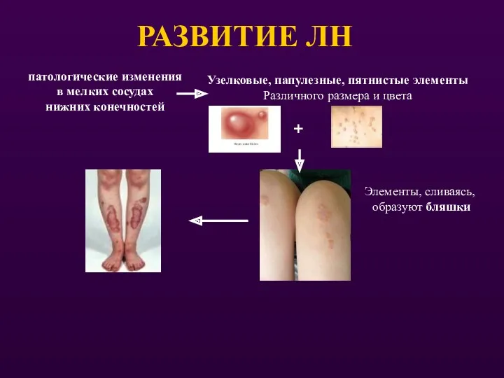 РАЗВИТИЕ ЛН патологические изменения в мелких сосудах нижних конечностей Узелковые,
