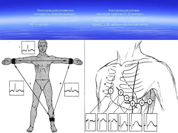 Электрокардиограмманың Электрокардиограмма- стандартты тіркелімі кезіндегі ның кеуде тіркелімі (1- 6)