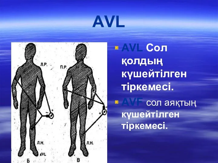 АVL АVL Сол қолдың күшейтілген тіркемесі. АVF сол аяқтың күшейтілген тіркемесі.