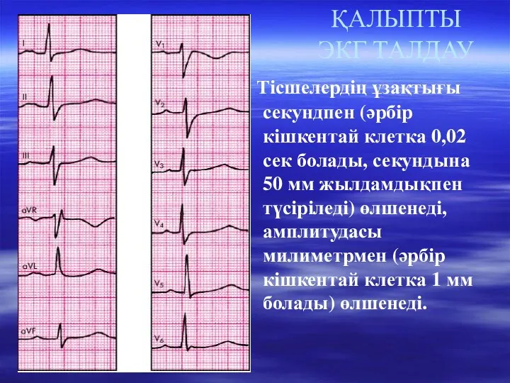 ҚАЛЫПТЫ ЭКГ ТАЛДАУ Тісшелердің ұзақтығы секундпен (әрбір кішкентай клетка 0,02