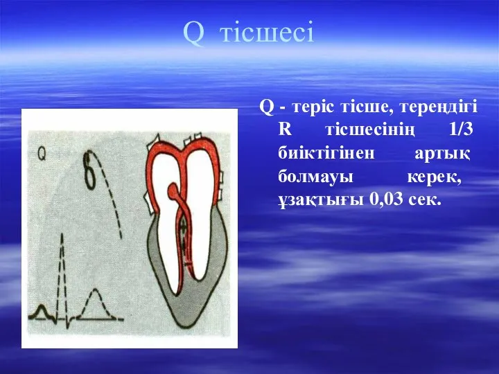 Q тісшесі Q - теріс тісше, тереңдігі R тісшесінің 1/3