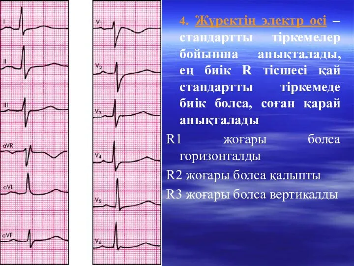 4. Жүректің электр осі – стандартты тіркемелер бойынша анықталады, ең