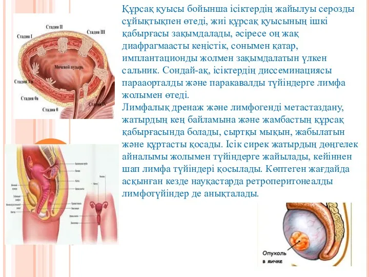 Құрсақ қуысы бойынша ісіктердің жайылуы серозды сұйықтықпен өтеді, жиі құрсақ