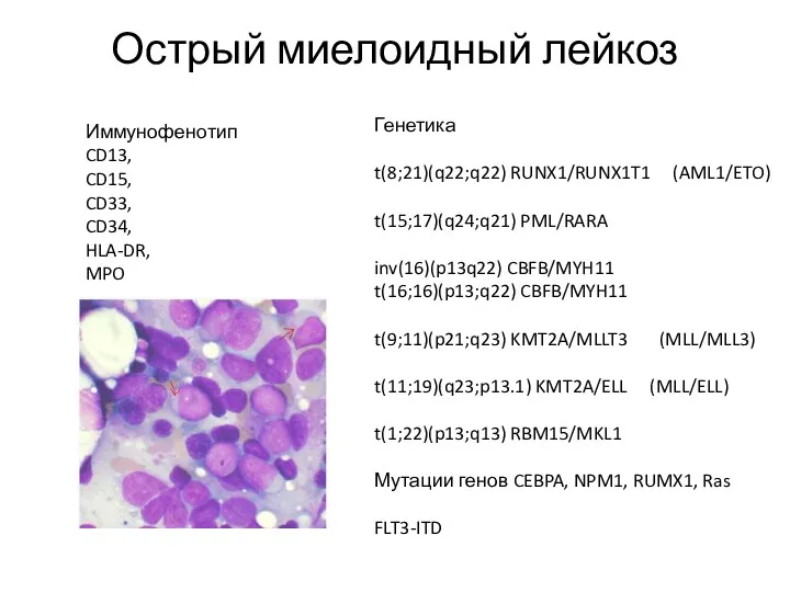 Острый миелоидный лейкоз Генетика t(8;21)(q22;q22) RUNX1/RUNX1T1 (AML1/ETO) t(15;17)(q24;q21) PML/RARA inv(16)(p13q22)