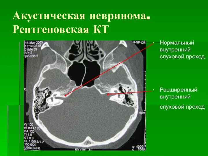 Акустическая невринома. Рентгеновская КТ Нормальный внутренний слуховой проход Расширенный внутренний слуховой проход