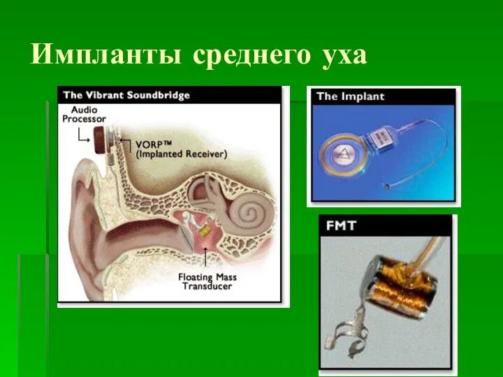Импланты среднего уха