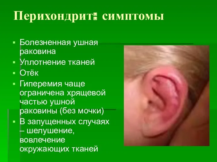 Перихондрит: симптомы Болезненная ушная раковина Уплотнение тканей Отёк Гиперемия чаще ограничена хрящевой частью