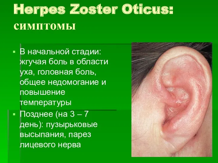 Herpes Zoster Oticus: симптомы В начальной стадии: жгучая боль в области уха, головная