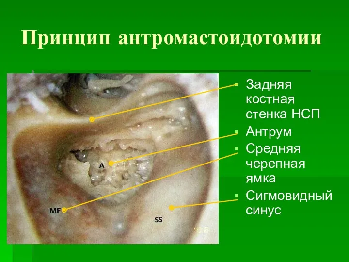 Принцип антромастоидотомии Задняя костная стенка НСП Антрум Средняя черепная ямка Сигмовидный синус