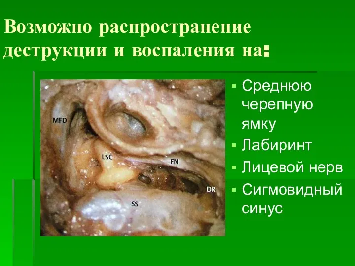 Возможно распространение деструкции и воспаления на: Среднюю черепную ямку Лабиринт Лицевой нерв Сигмовидный синус