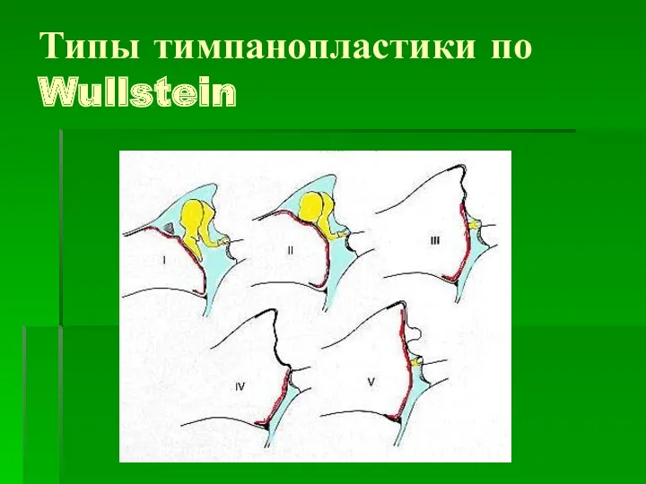 Типы тимпанопластики по Wullstein