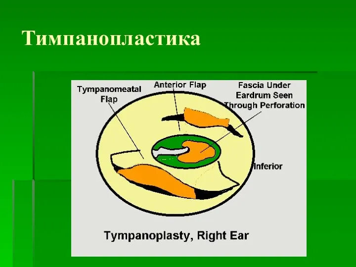 Тимпанопластика