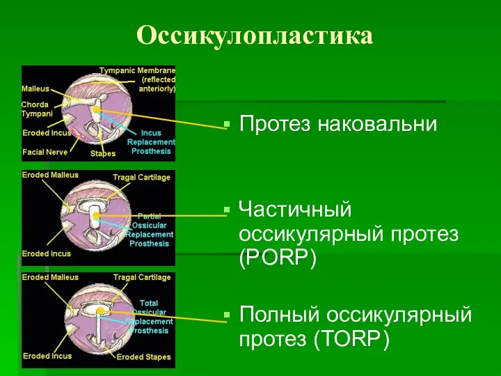 Оссикулопластика Протез наковальни Частичный оссикулярный протез (PORP) Полный оссикулярный протез (TORP)