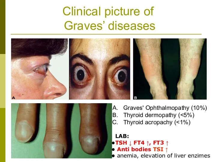 Clinical picture of Graves’ diseases Graves' Ophthalmopathy (10%) Thyroid dermopathy
