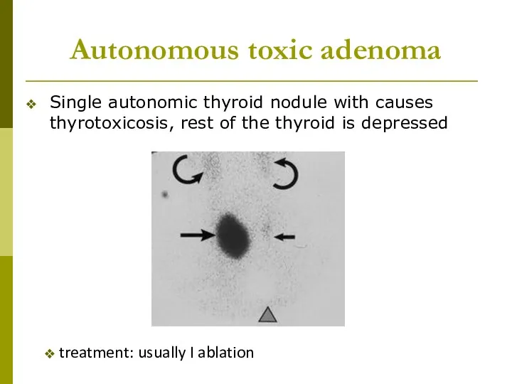 Autonomous toxic adenoma Single autonomic thyroid nodule with causes thyrotoxicosis, rest of the