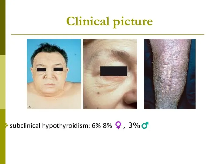 Clinical picture subclinical hypothyroidism: 6%-8% ♀, 3%♂