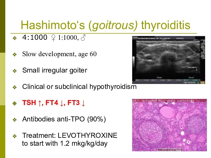 Hashimoto‘s (goitrous) thyroiditis 4:1000 ♀ 1:1000, ♂ Slow development, age