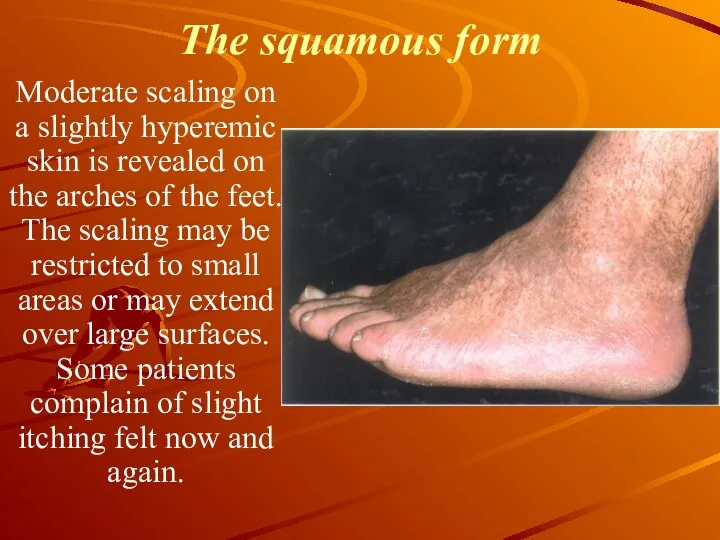 The squamous form Moderate scaling on a slightly hyperemic skin