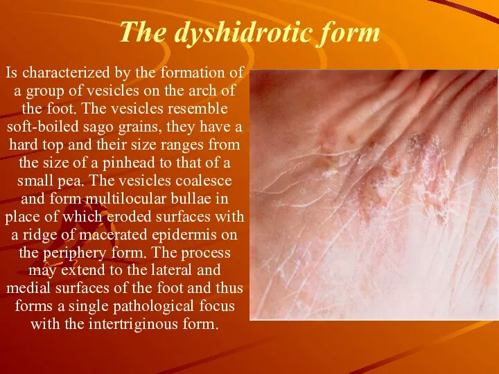 The dyshidrotic form Is characterized by the formation of a