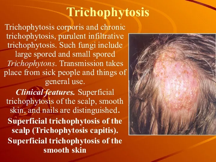 Trichophytosis Trichophytosis corporis and chronic trichophytosis, purulent infiltrative trichophytosis. Such