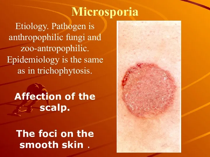 Microsporia Etiology. Pathogen is anthropophilic fungi and zoo-antropophilic. Epidemiology is