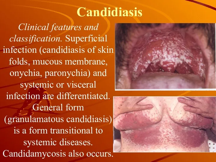 Candidiasis Clinical features and classification. Superficial infection (candidiasis of skin