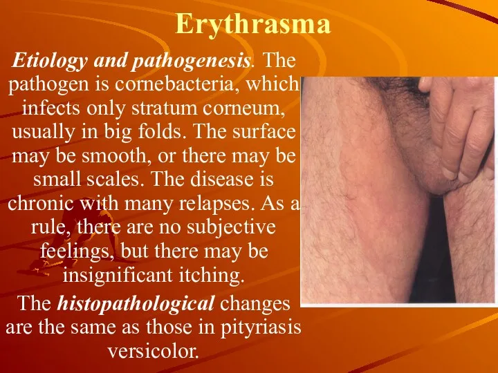 Erythrasma Etiology and pathogenesis. The pathogen is cornebacteria, which infects