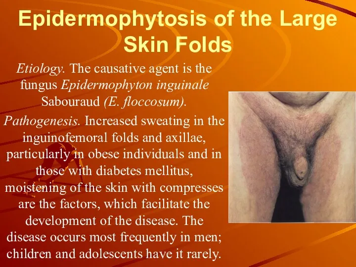 Epidermophytosis of the Large Skin Folds Etiology. The causative agent
