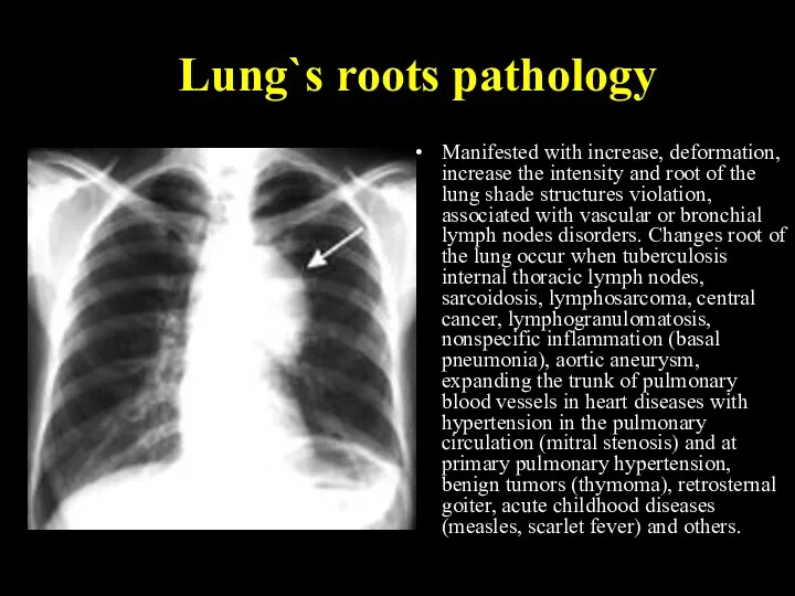 Lung`s roots pathology Manifested with increase, deformation, increase the intensity