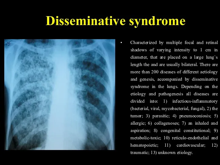 Disseminative syndrome Characterized by multiple focal and retinal shadows of