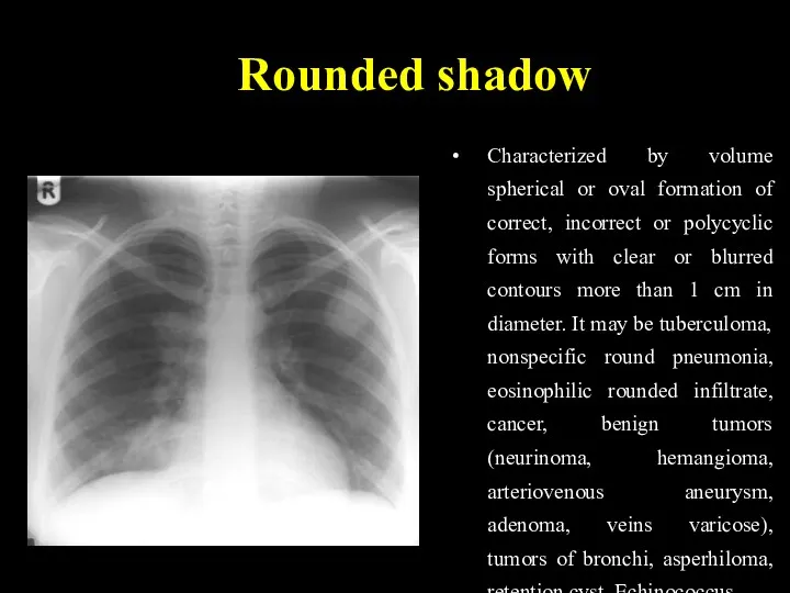 Rounded shadow Characterized by volume spherical or oval formation of
