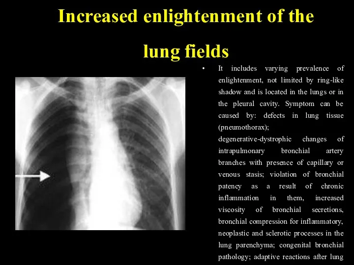 Increased enlightenment of the lung fields It includes varying prevalence