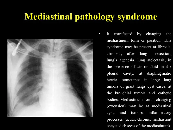 Mediastinal pathology syndrome It manifested by changing the mediastinum form