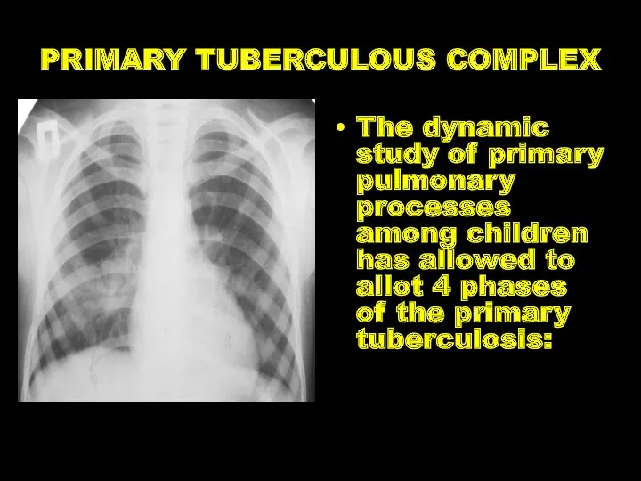 PRIMARY TUBERCULOUS COMPLEX The dynamic study of primary pulmonary processes