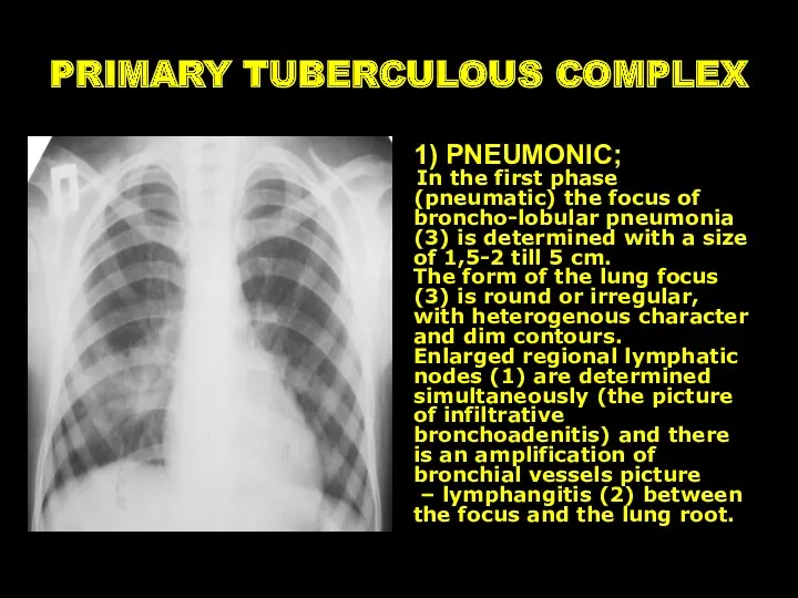 PRIMARY TUBERCULOUS COMPLEX 1) PNEUMONIC; In the first phase (pneumatic)