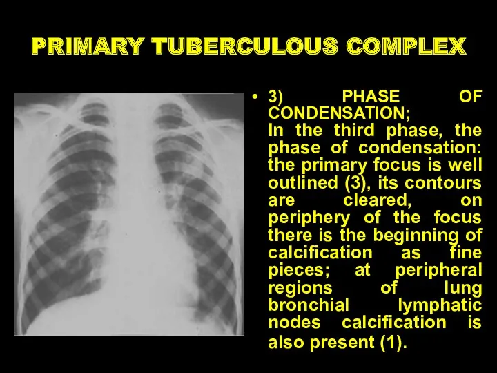 PRIMARY TUBERCULOUS COMPLEX 3) PHASE OF CONDENSATION; In the third