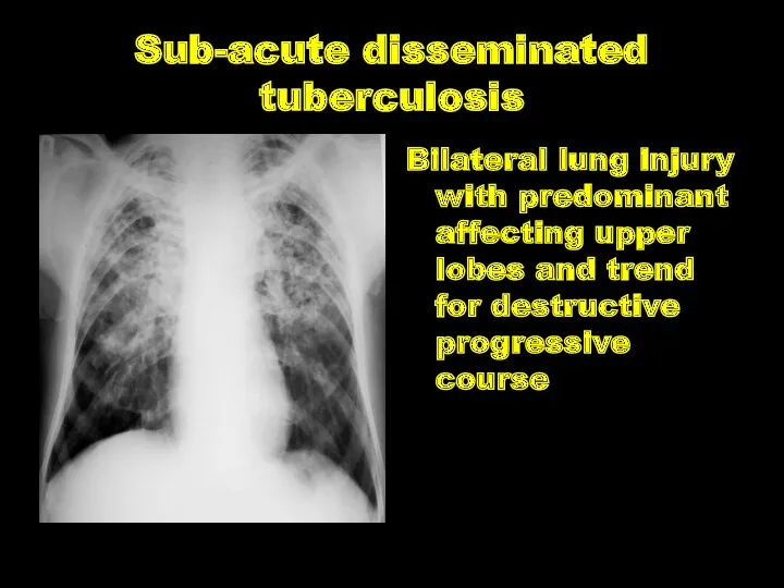 Sub-acute disseminated tuberculosis Bilateral lung injury with predominant affecting upper