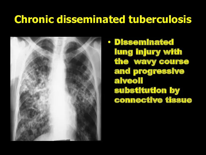 Chronic disseminated tuberculosis Disseminated lung injury with the wavy course