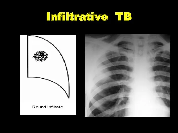 Infiltrative TB