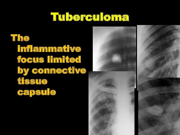 Tuberculoma The inflammative focus limited by connective tissue capsule