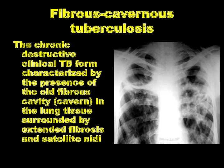 Fibrous-cavernous tuberculosis The chronic destructive clinical TB form characterized by