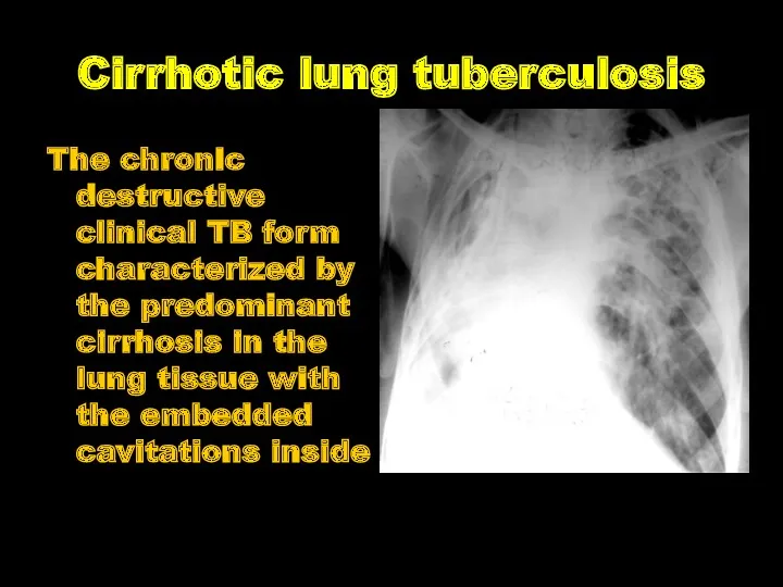 Cirrhotic lung tuberculosis The chronic destructive clinical TB form characterized