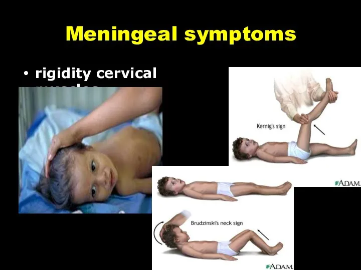 Meningeal symptoms rigidity cervical muscles