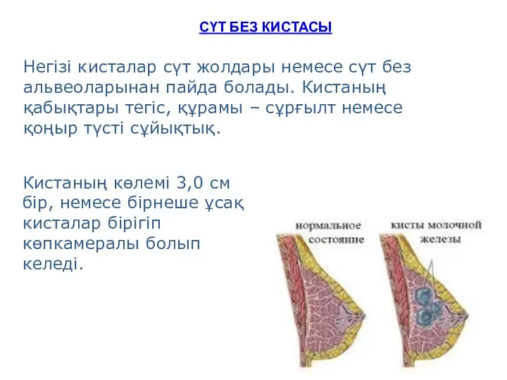 CҮТ БЕЗ КИСТАСЫ Негізі кисталар сүт жолдары немесе сүт без