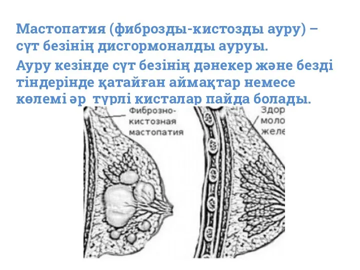 Мастопатия (фиброзды-кистозды ауру) – сүт безінің дисгормоналды ауруы. Ауру кезінде