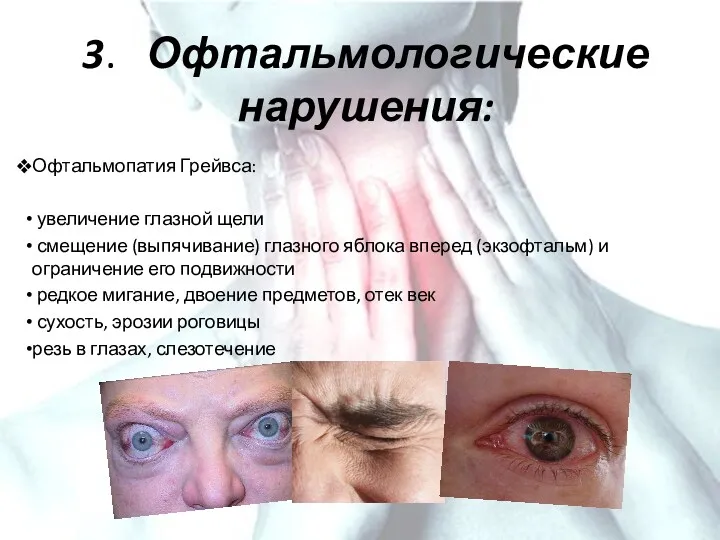 3. Офтальмологические нарушения: Офтальмопатия Грейвса: увеличение глазной щели смещение (выпячивание)