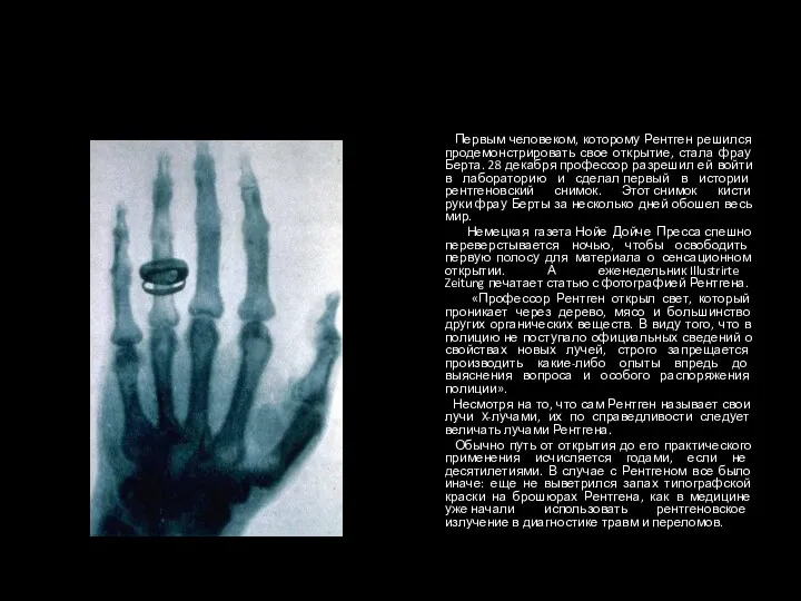 Первым человеком, которому Рентген решился продемонстрировать свое открытие, стала фрау
