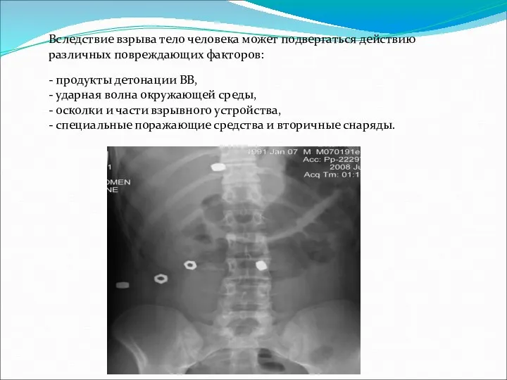 Вследствие взрыва тело человека может подвергаться действию различных повреждающих факторов: