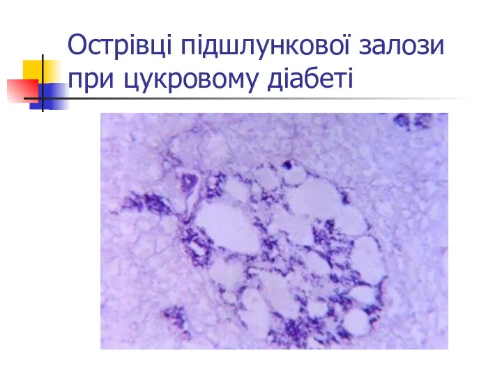 Острівці підшлункової залози при цукровому діабеті