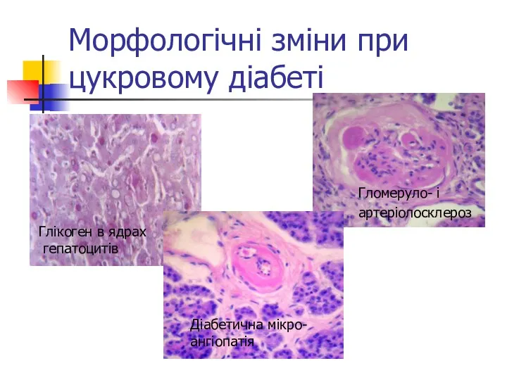 Морфологічні зміни при цукровому діабеті Глікоген в ядрах гепатоцитів Гломеруло- і артеріолосклероз Діабетична мікро- ангіопатія